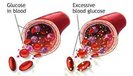 excess-sugar-in-the-blood
