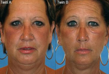 smoking-effects-pictures-s1